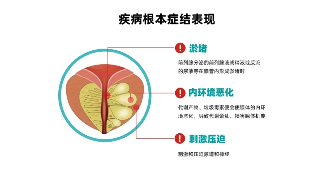 尿频尿急起夜，前列腺炎问题的根本病因究竟是什么？-前列腺论坛