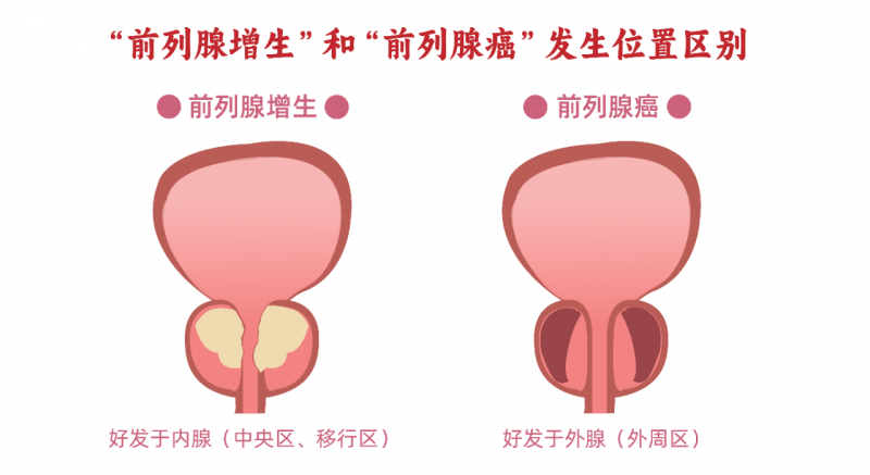 检查前列腺体积，“超标”了就是前列腺增生BPH吗？-前列腺论坛