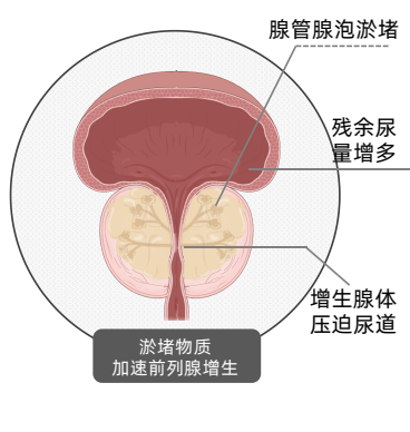 清除淤堵，恢复腺体机能，才是从根源处解决前列腺炎增生问题-病友交流论坛-前列腺病友交流-前列腺论坛