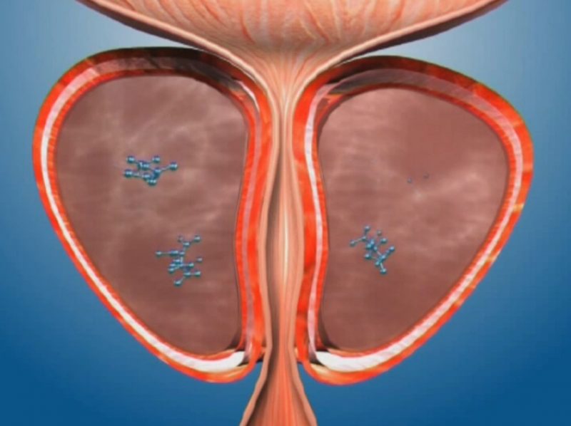 滇鹤堂清淤疗法,清瘀组方下清茶方子治疗原理和优势-前列腺论坛