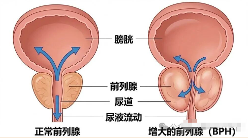 男性前列腺增生的“防”与“治”（小便夜尿频繁增多）-前列腺论坛